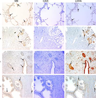 Expression of Myoglobin in Normal and Cancer Brain Tissues: Correlation With Hypoxia Markers